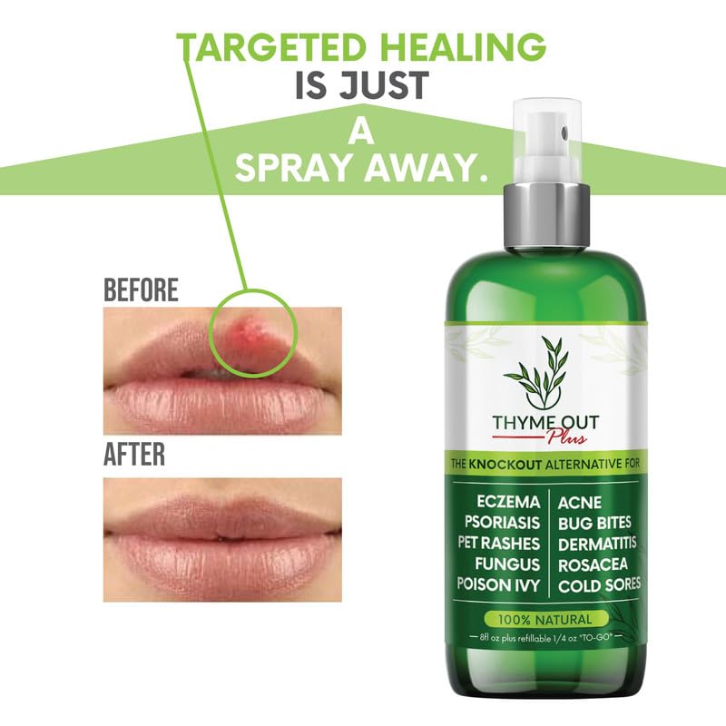 Thyme Out Plus All-Natural Skin Soothing Spray — Eczema, Rosacea, Psoriasis & More | Thyme Out