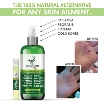 Thyme Out Plus All-Natural Skin Soothing Spray — Eczema, Rosacea, Psoriasis & More | Thyme Out