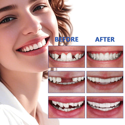 Tooth Repair Kit - Moldable False Teeth for Temporary Tooth Replacement (50ML)