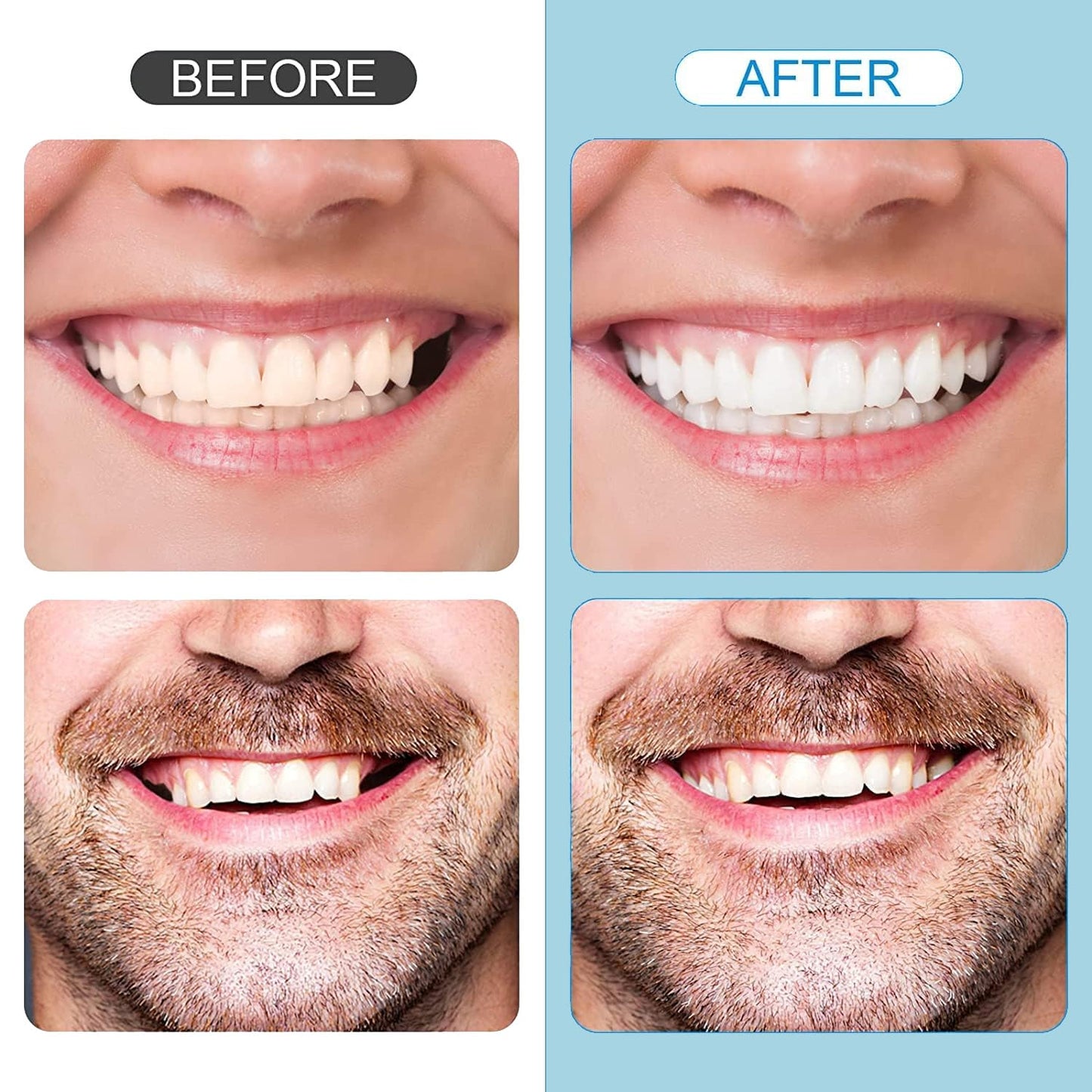 Tooth Repair Kit - Temporary Natural Shade Moldable Beads for DIY Tooth Replacement (6PCS)