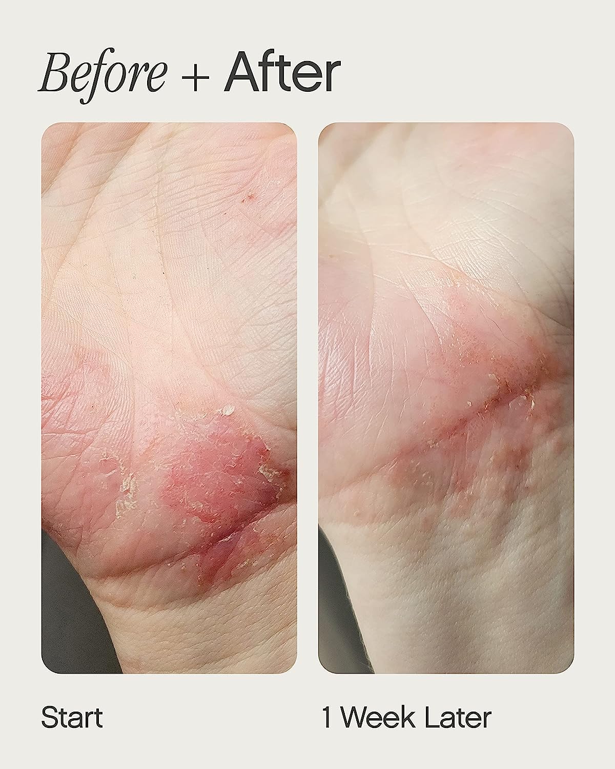 Topicals Like Butter Moisturizer – Dry, Sensitive & Eczema-Prone Skin