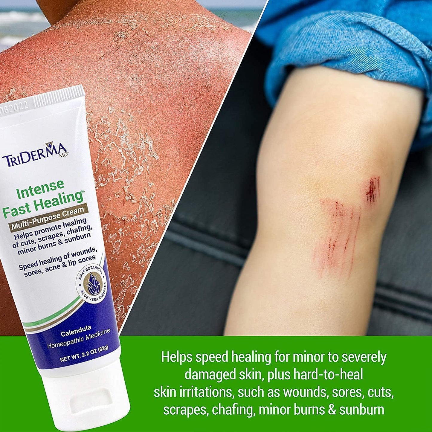 TriDerma MD Intense Fast Healing Cream – FSA Eligible, 2.2 oz