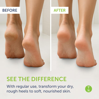 Truremedy Naturals Remedy Balm with Tea Tree Oil – Soothing Foot & Body Moisturizer (2 oz) with Lavender & Eucalyptus