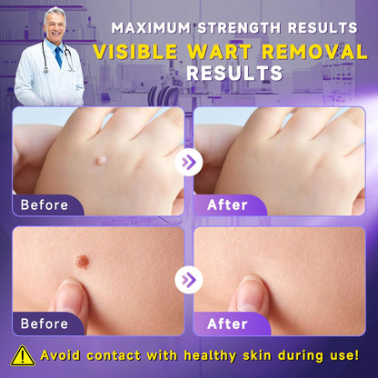 TTsiya Wart Remover Cream & Liquid Freeze Off – Fast Acting Salicylic Acid Wart Treatment (20g & 30ml)