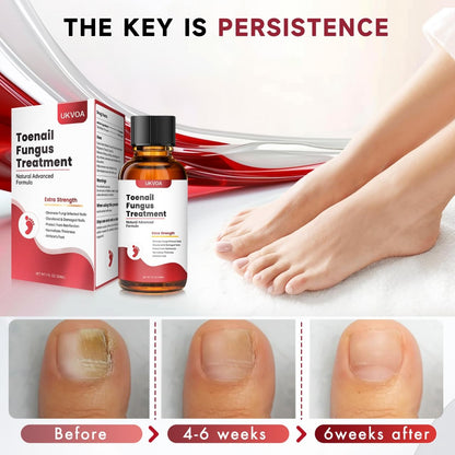 UKVOA Toenail Fungus Treatment Extra Strength Upgraded – Nail Repair for Thick, Discolored Nails