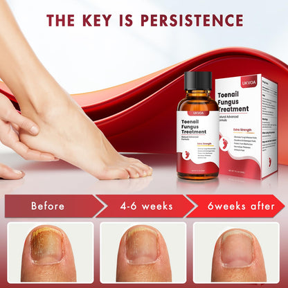 UKVOA Toenail Fungus Treatment Extra Strength Upgraded – Nail Repair for Thick, Discolored Nails