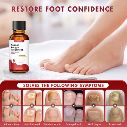 UKVOA Toenail Fungus Treatment Extra Strength Upgraded – Nail Repair for Thick, Discolored Nails