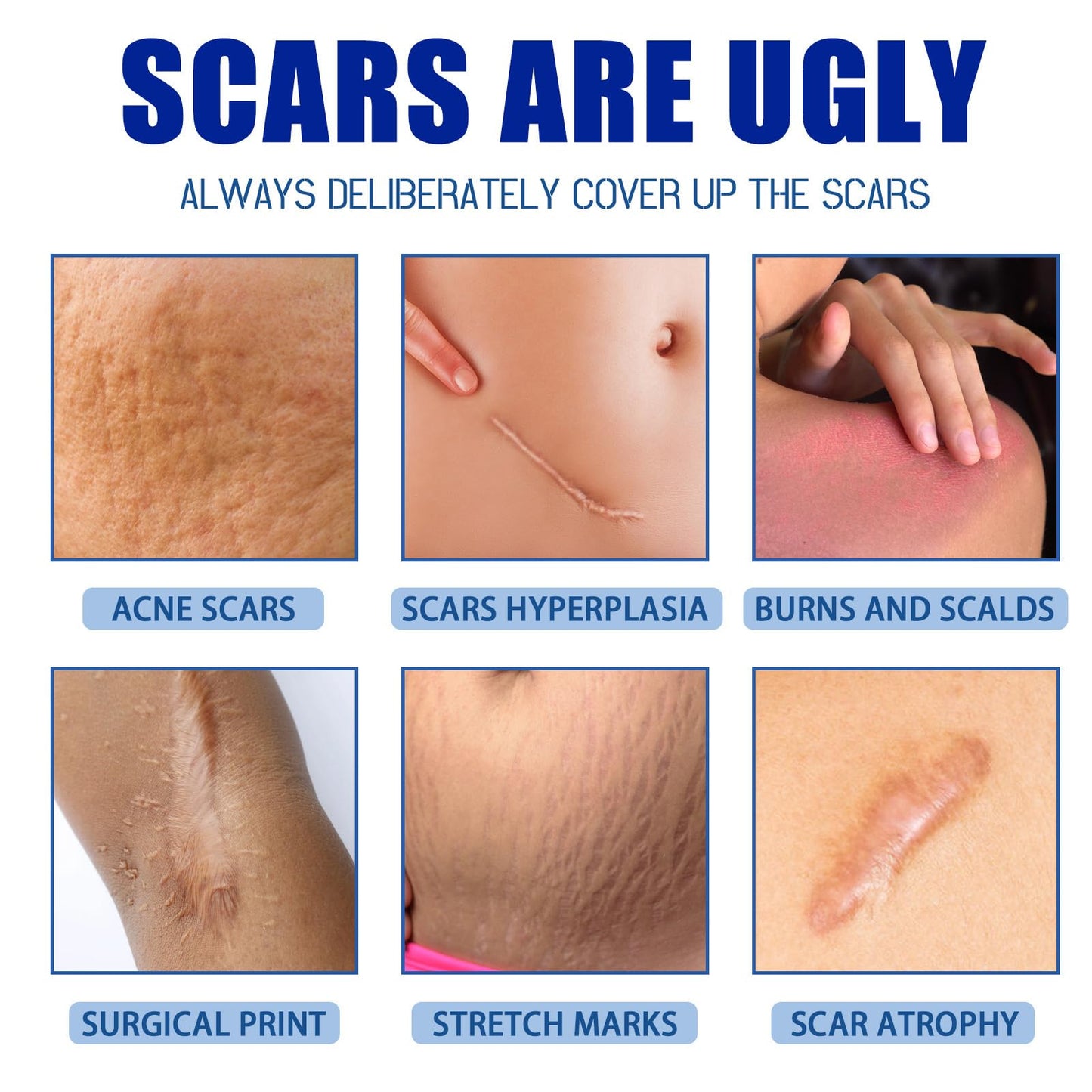 URABOS Scar Cream + Silicone Gel — Scar Treatment for Surgical Scars, Stretch Marks & Keloids (2pcs)