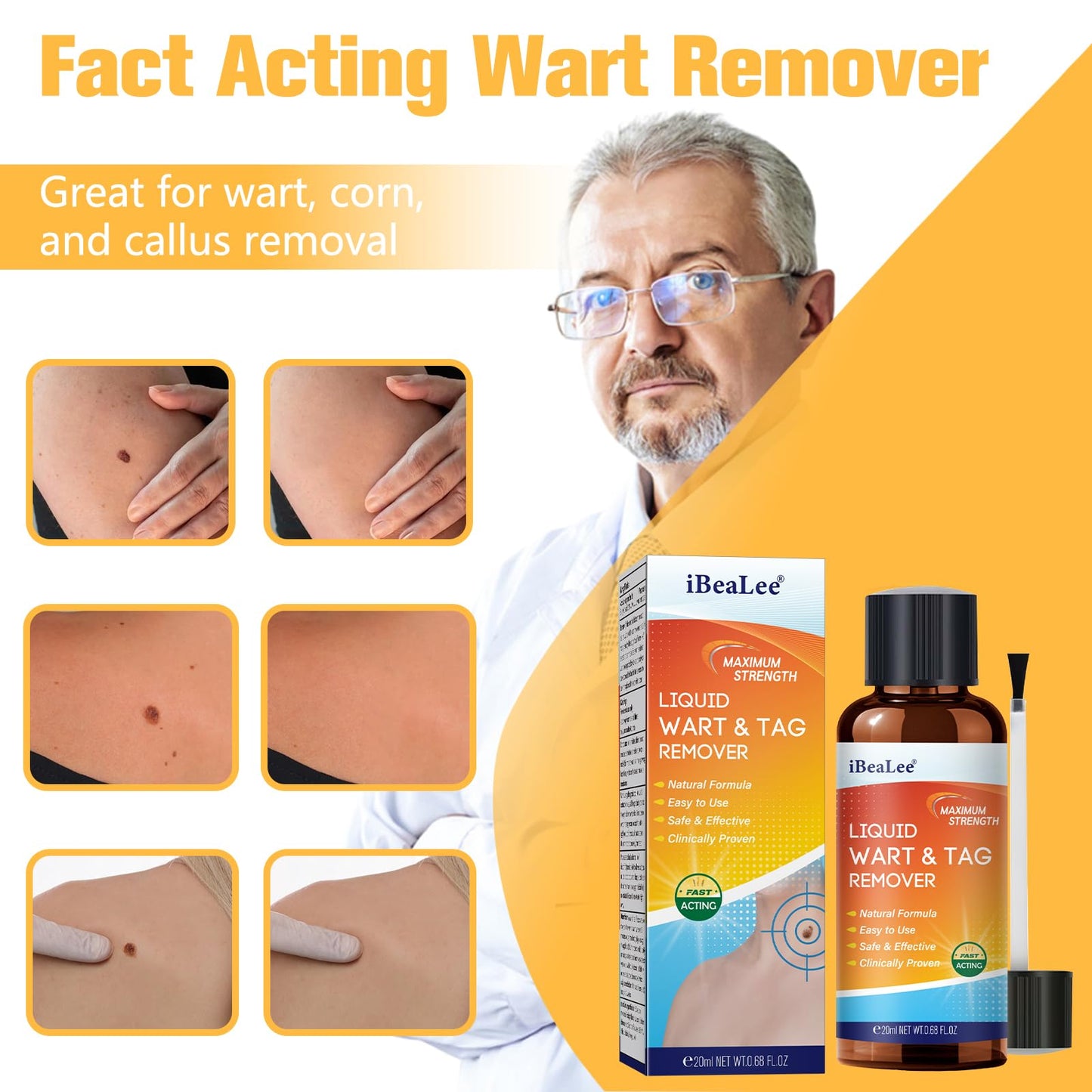 URSEORY Skin Tag Remover — Fast-Acting Wart Freeze Off with 12% Salicylic Acid (A4)