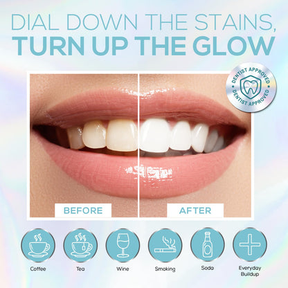 Venus Visage LED Teeth Whitening Kit – 4x 35% Carbamide Peroxide, Remineralization Gel, LED Light, Trays & Shade Guide