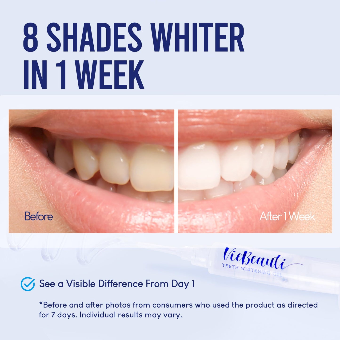 VieBeauti LED Teeth Whitening Kit – Sensitive Teeth, 35% Carbamide Peroxide