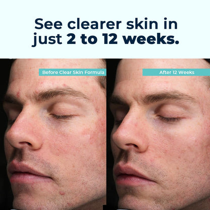 VitaMedica Clear Skin Vitamin Formula | Noncystic Acne Supplement for Clear Complexion | 60 Count