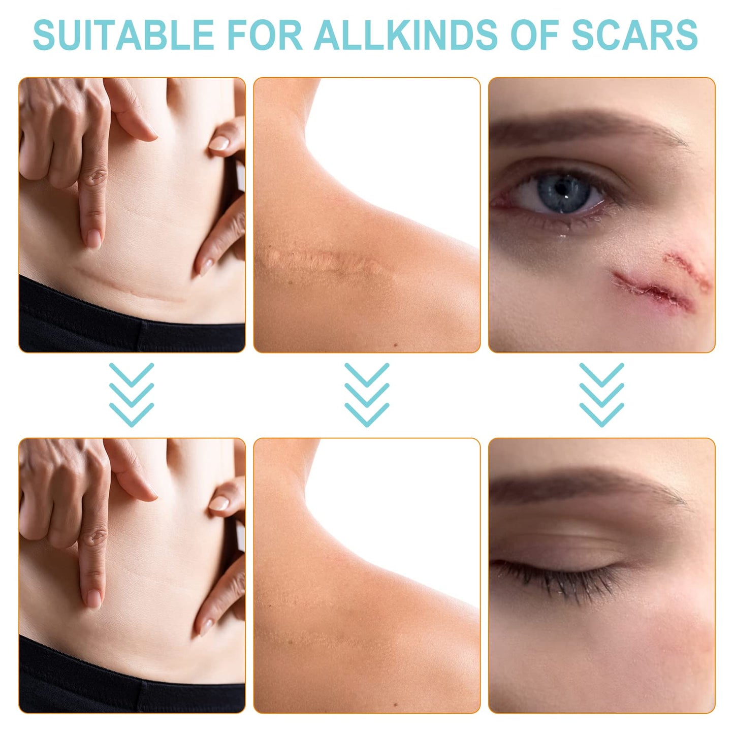 Vortexonix Silicone Scar Sheets – Medical-Grade Soft Silicone Scar Tape (1.6in x 150in, approx. 3.8m)