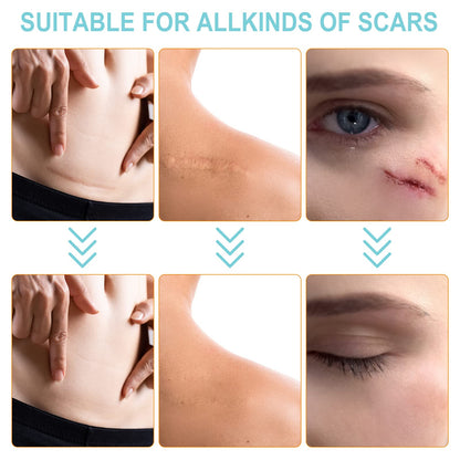 Vortexonix Silicone Scar Sheets – Medical-Grade Soft Silicone Scar Tape (1.6in x 150in, approx. 3.8m)