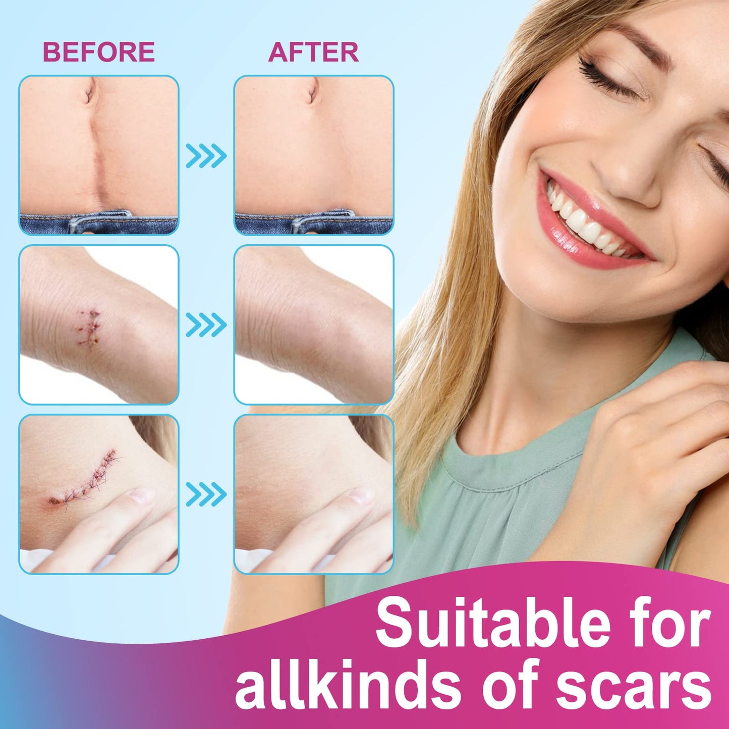 Vortexonix Silicone Scar Sheets | Medical-Grade Soft Silicone Tape (1.6” x 75” / 1.9m)