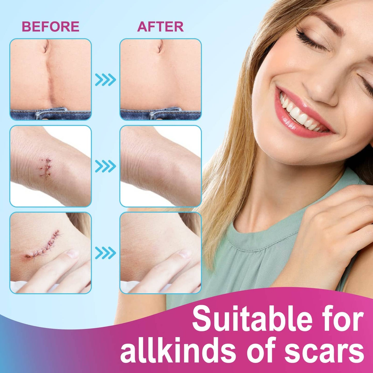 Vortexonix Silicone Scar Sheets | Medical-Grade Soft Silicone Tape (1.6” x 75” / 1.9m)