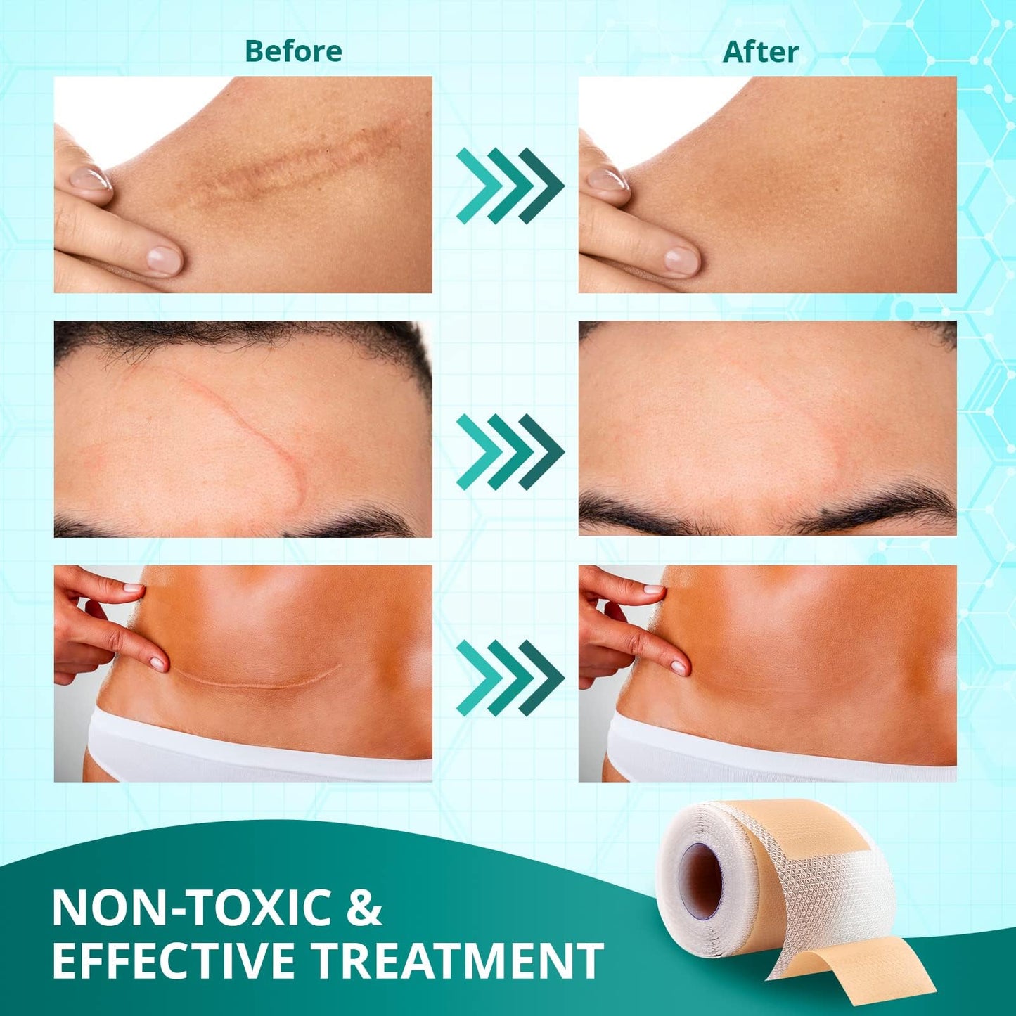 Vxoyo Silicone Scar Sheets — Reusable 1.6x60 Roll for Scar Care (Surgical, Keloid, Burns)