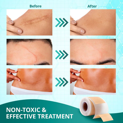 Vxoyo Silicone Scar Sheets — Reusable 1.6x60 Roll for Scar Care (Surgical, Keloid, Burns)