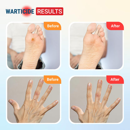 Warticide Liquid Wart Remover – 10% Salicylic Acid, Tea Tree & Cedar Leaf – Genital & Plantar Wart Treatment (USA Made) – 3-Pack