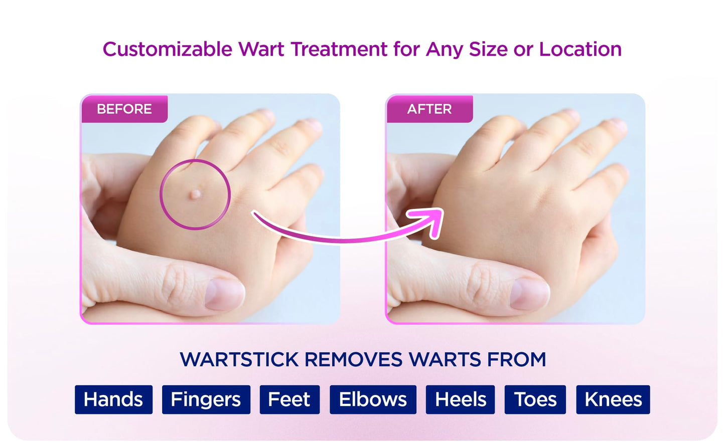 WartStick Maximum Strength Salicylic Acid Solid-Stick Wart Remover 2 Pack – 0.4 oz