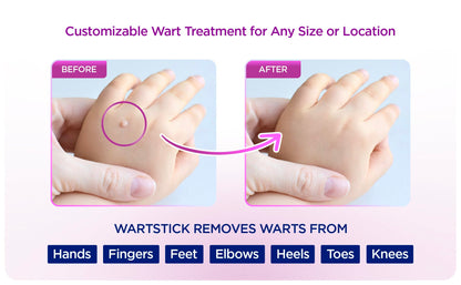 WartStick Maximum Strength Salicylic Acid Solid-Stick Wart Remover 2 Pack – 0.4 oz