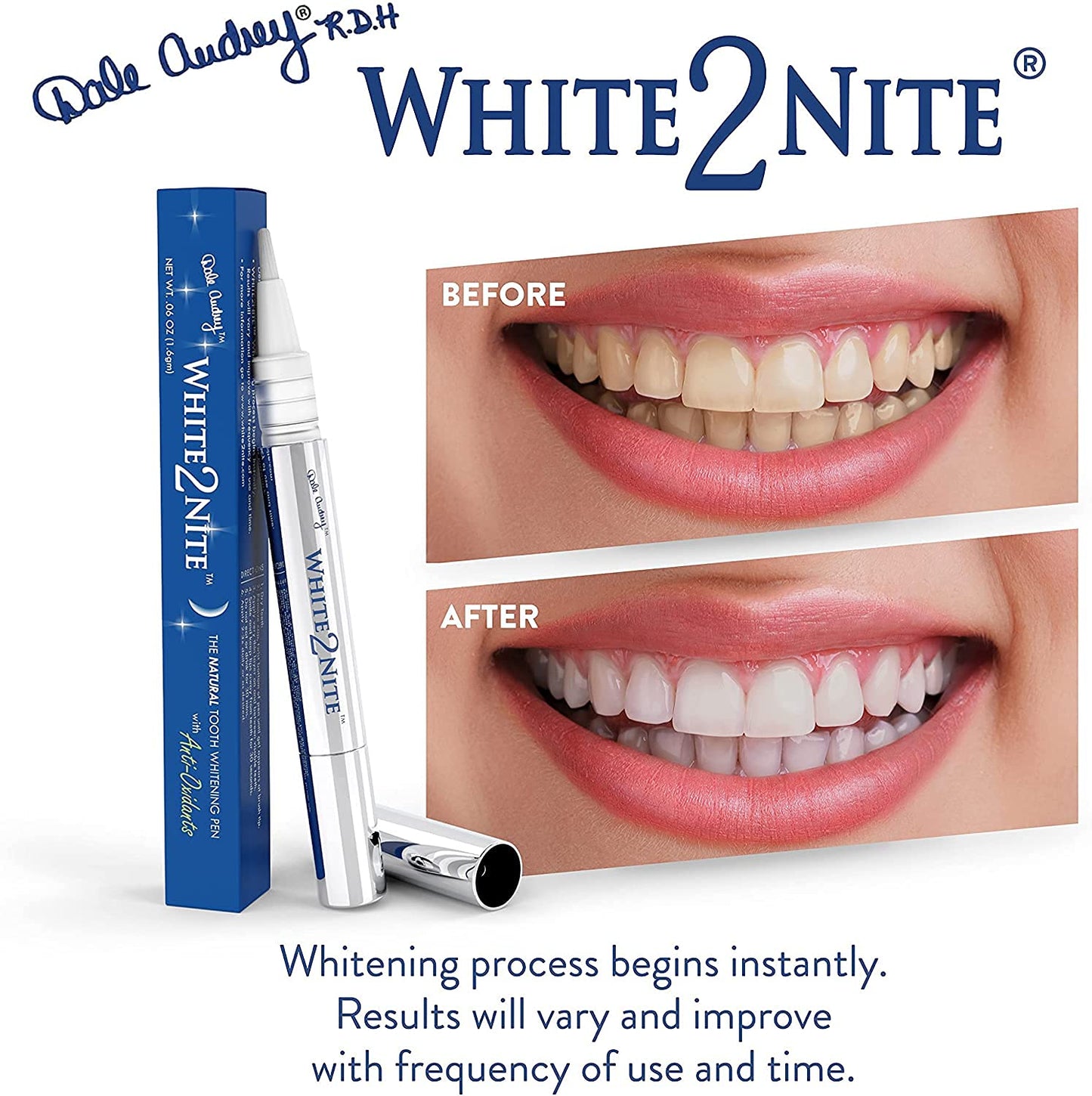 White2nite Teeth Whitening Pen | Enamel Safe, Dentist-Recommended