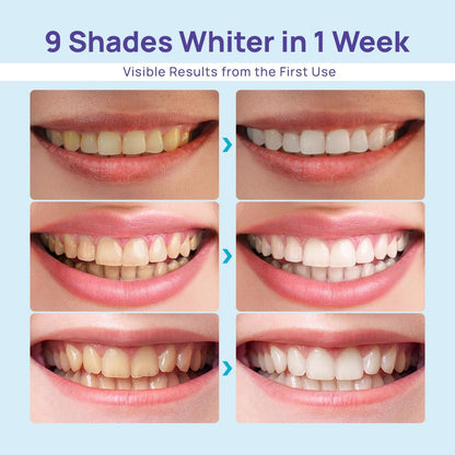 Whitebite Pro Teeth Whitening Kit for Sensitive Teeth – Dual LED, 35% Carbamide Peroxide Gel, Remineralizing Gel | At-Home Whitening