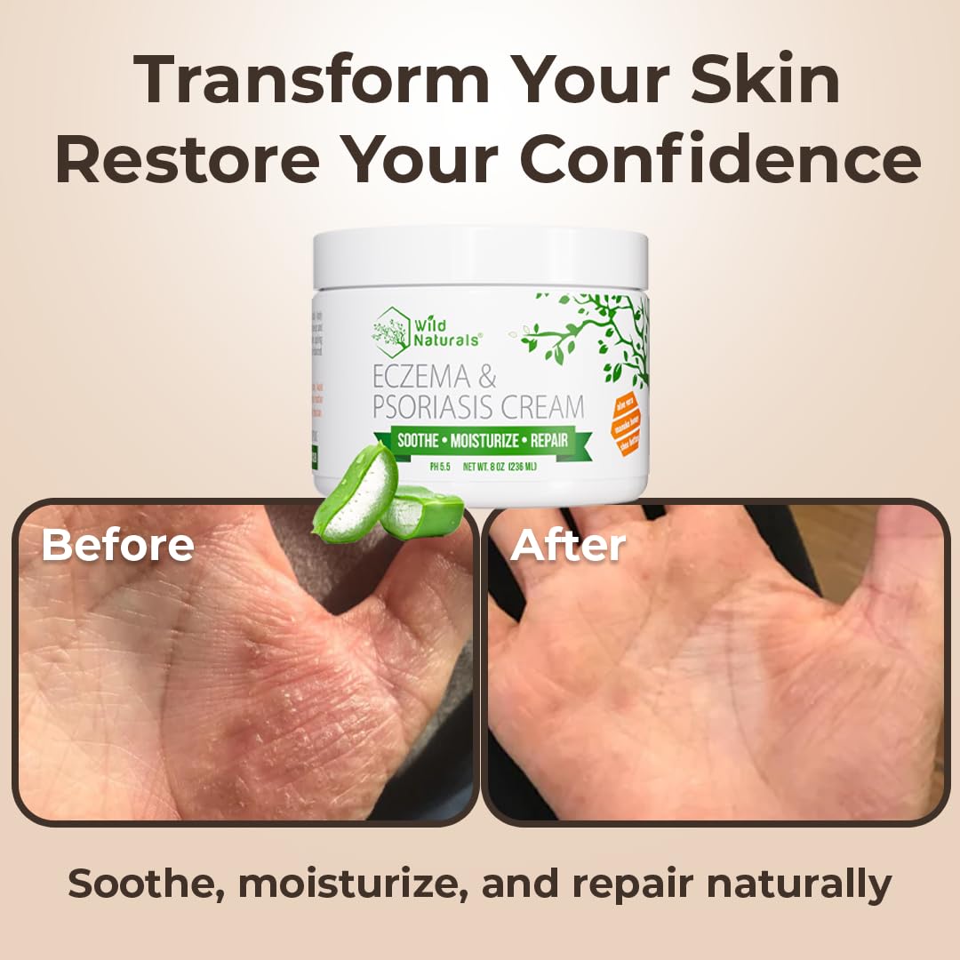 Wild Naturals Eczema & Psoriasis Cream with Manuka Honey – Hydrating, Gentle Relief