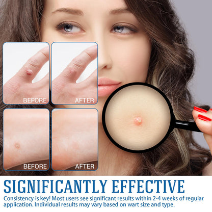 YEHOYOD Fast-Acting Skin Tag Removal Kit - Gentle, Pain-Free, Fast Results