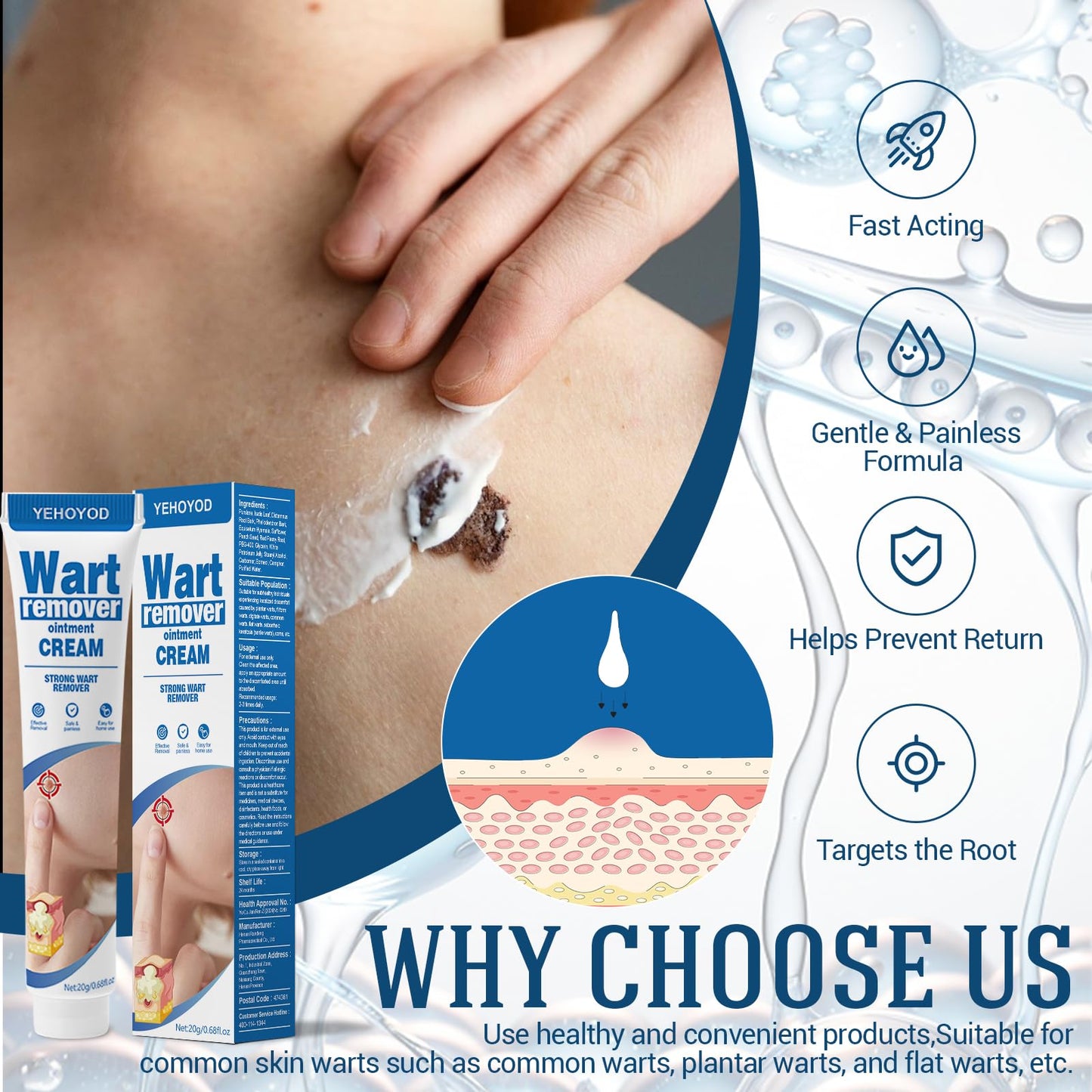 YEHOYOD Fast-Acting Skin Tag Removal Kit - Gentle, Pain-Free, Fast Results