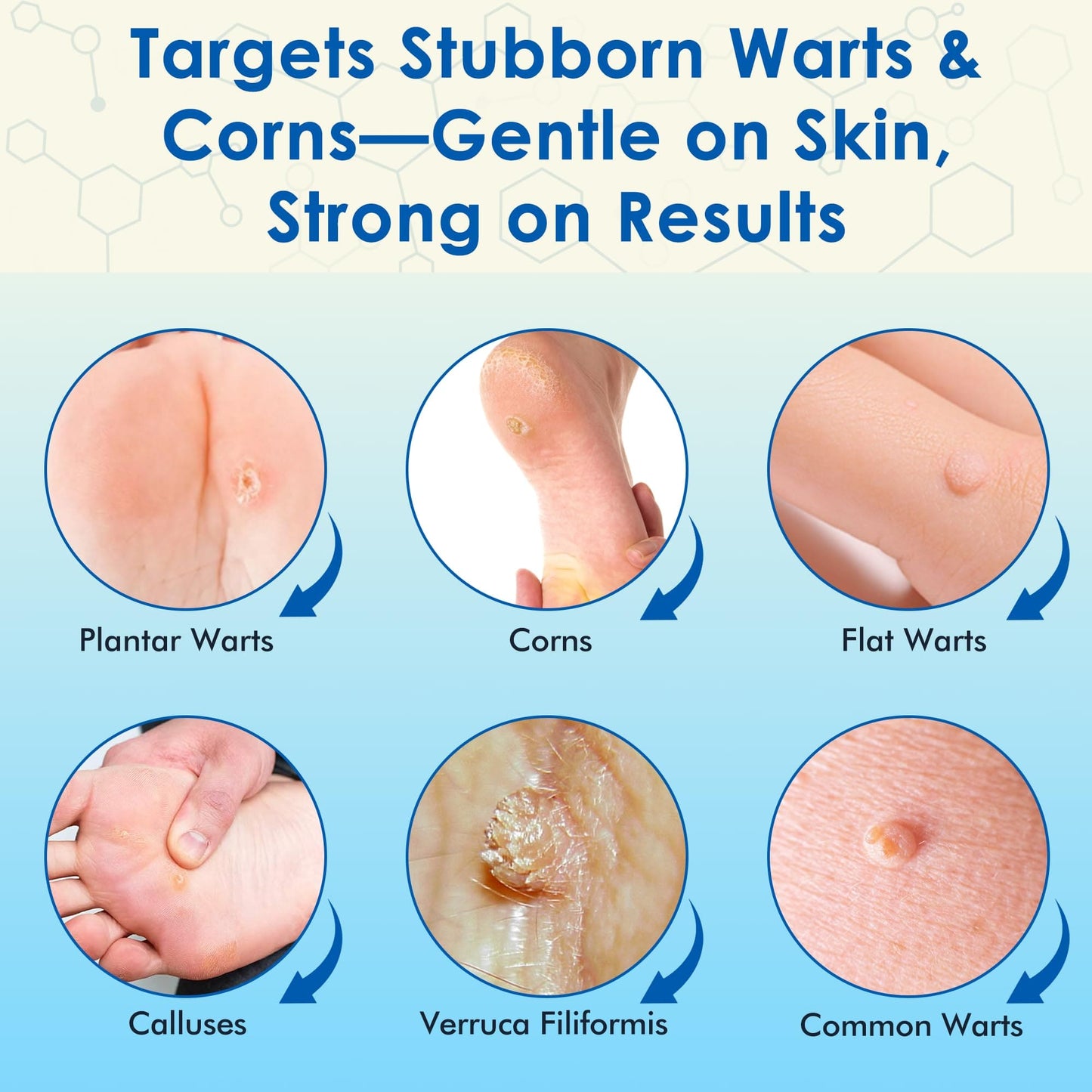 ZGjoib TAG Wart Remover Freeze Off Liquid 17% Salicylic Acid – 1oz Wart Treatment