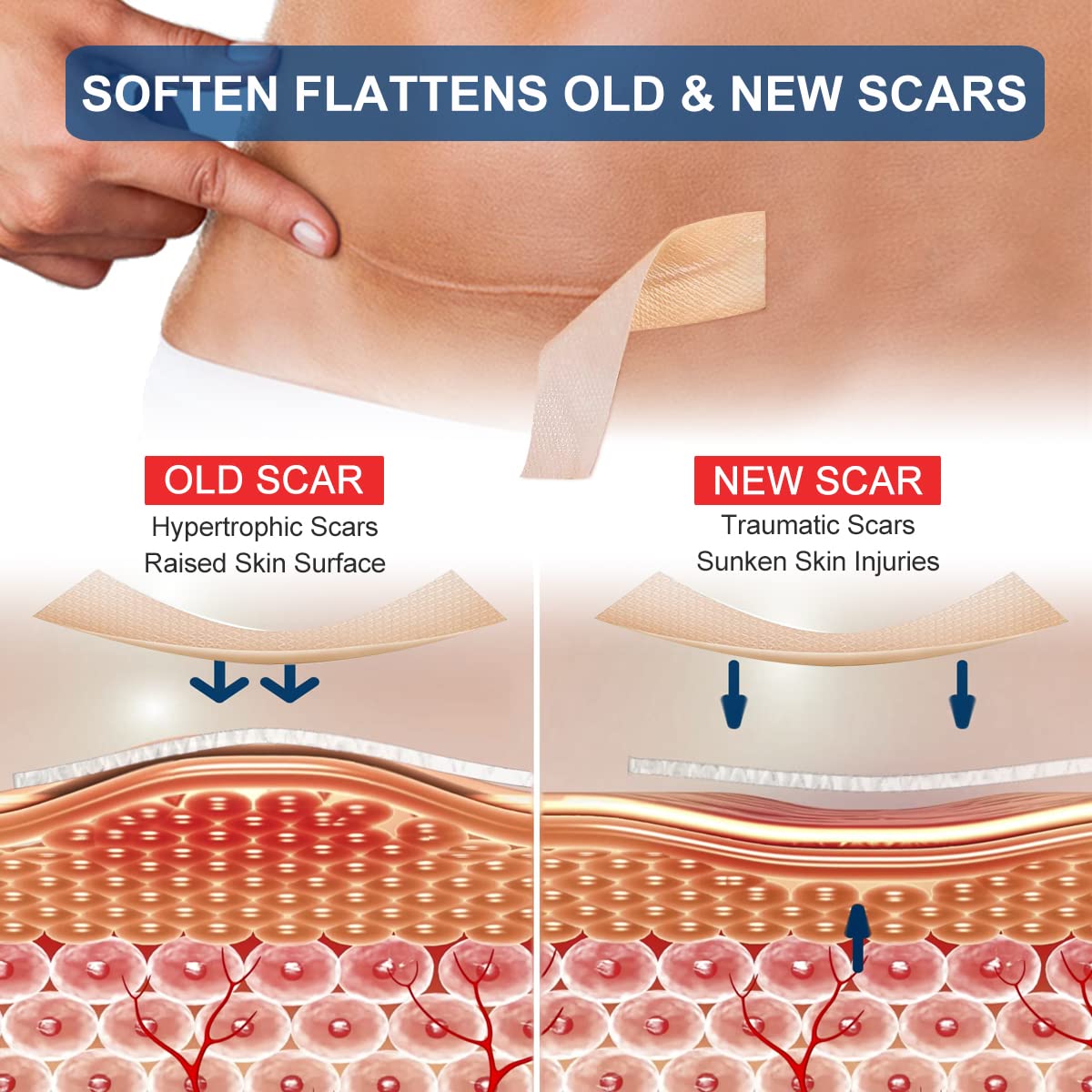 ZODENIS Silicone Scar Sheets – 1.6” x 120” Roll (3M) for Scar Care