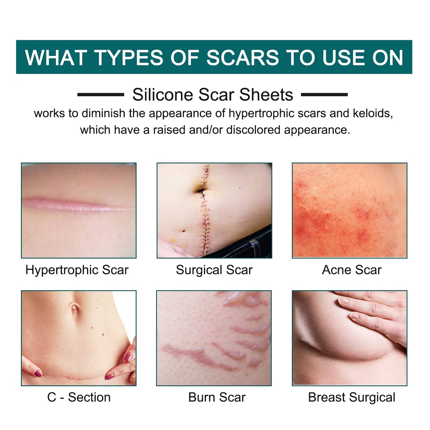 ZODENIS Silicone Scar Sheets – 1.6” x 120” Roll (3M) for Scar Care