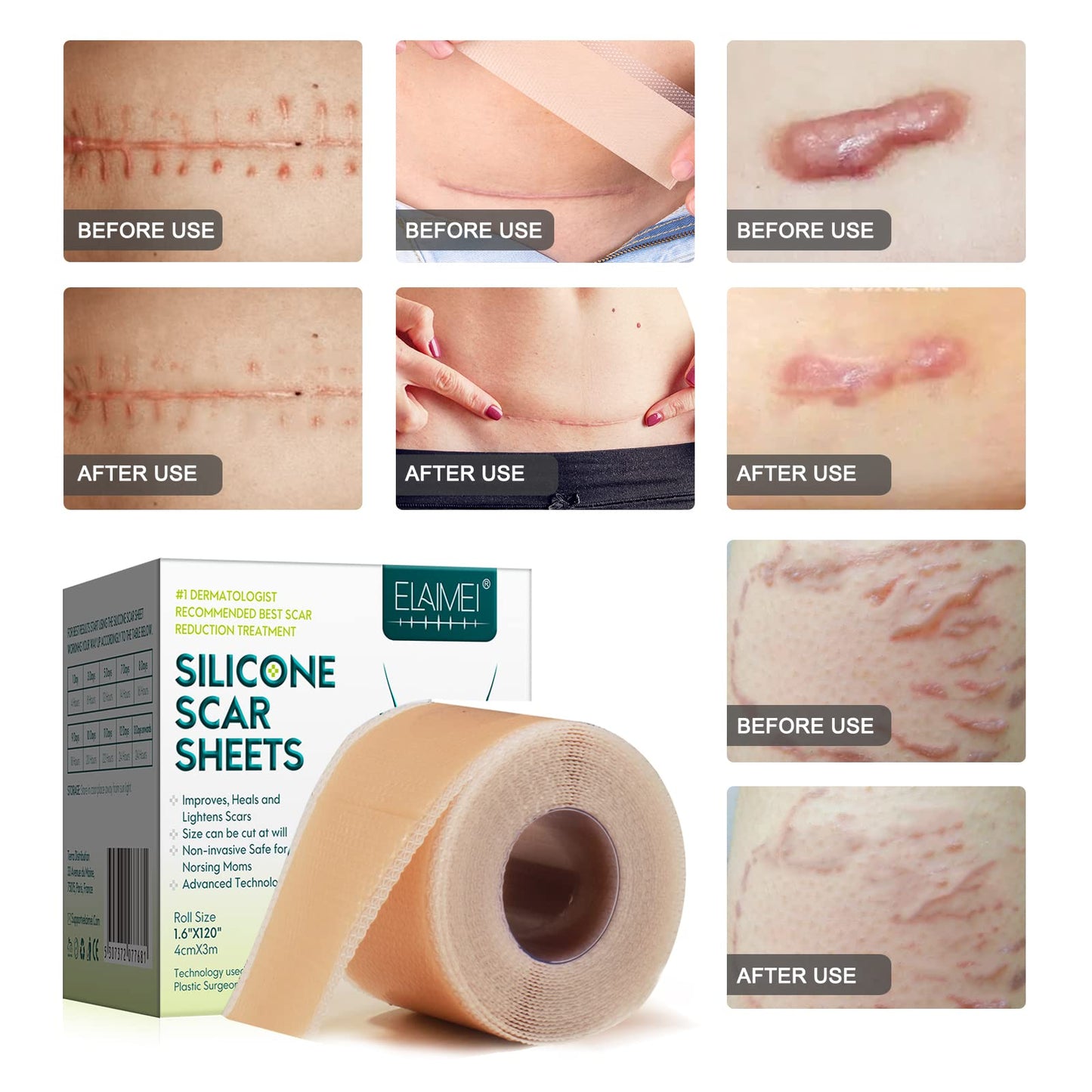 ZODENIS Silicone Scar Sheets – 1.6” x 120” Roll (3M) for Scar Care