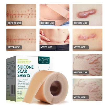 ZODENIS Silicone Scar Sheets – 1.6” x 120” Roll (3M) for Scar Care