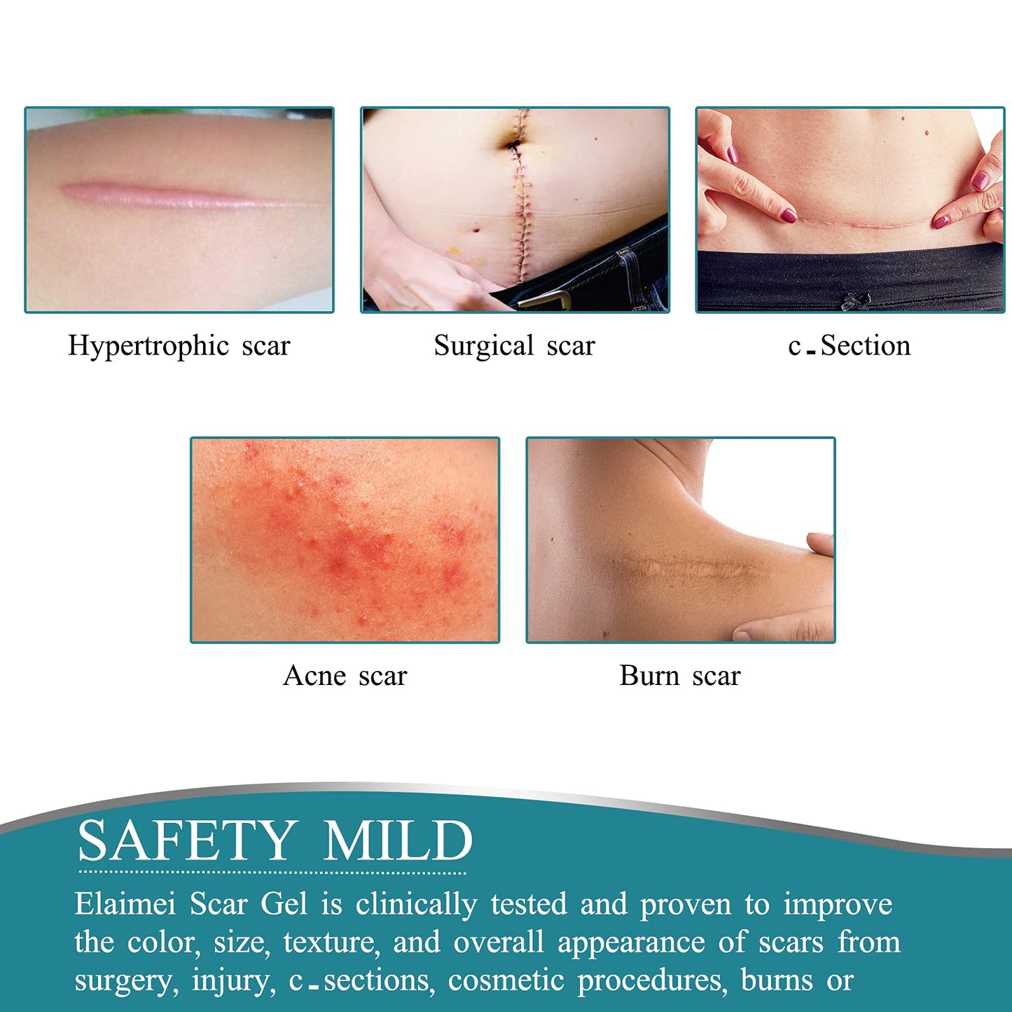 ZODENIS Medical Grade Silicone Scar Tape – 1.6” x 60” Scar Sheets (6–8 Month Supply)